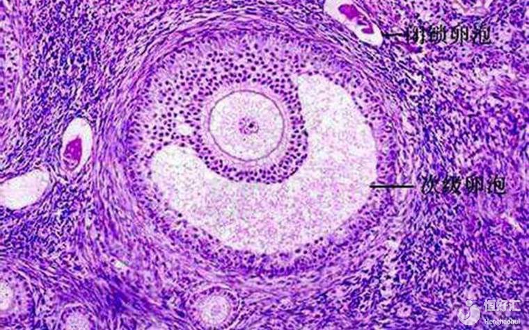 馬來西亞試管促排卵期間，卵泡早排的原因及應對方法